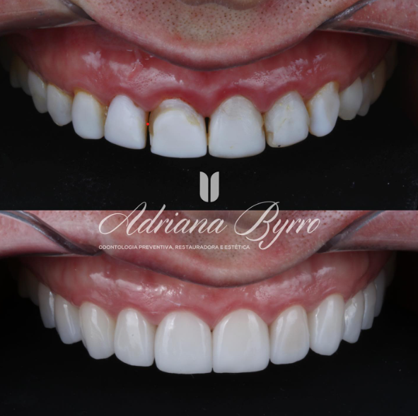 Antes e depois Lente de Contato Dental BH