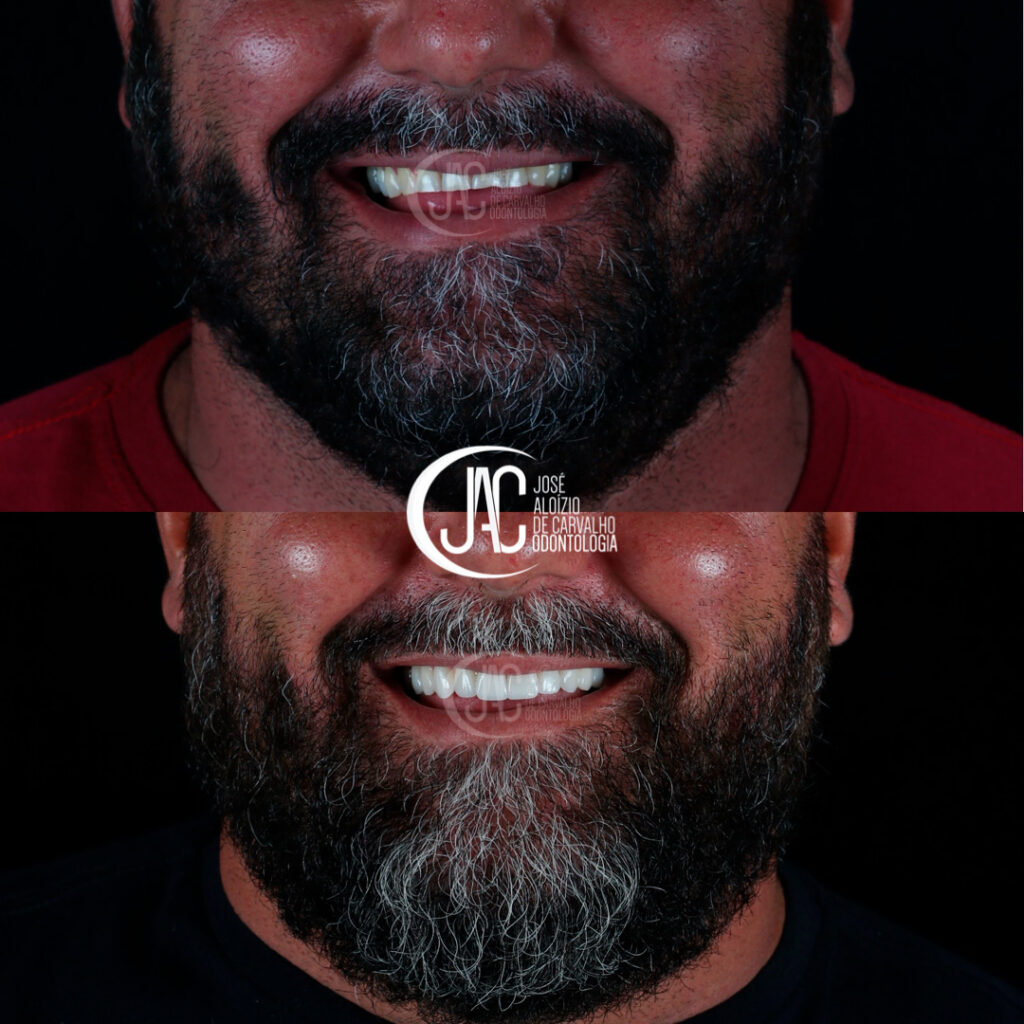 Invisalign e Facetas de Porcelana