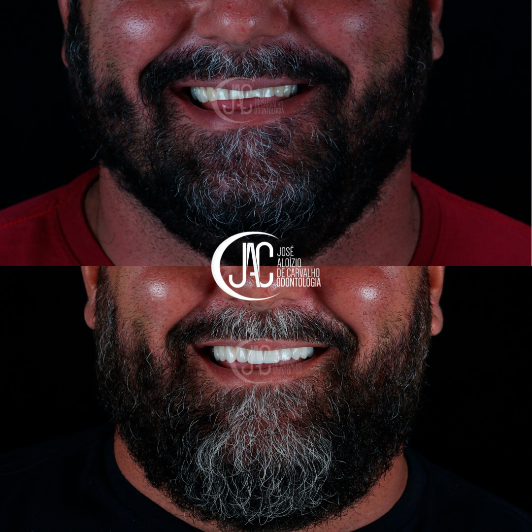 Invisalign e Facetas de Porcelana