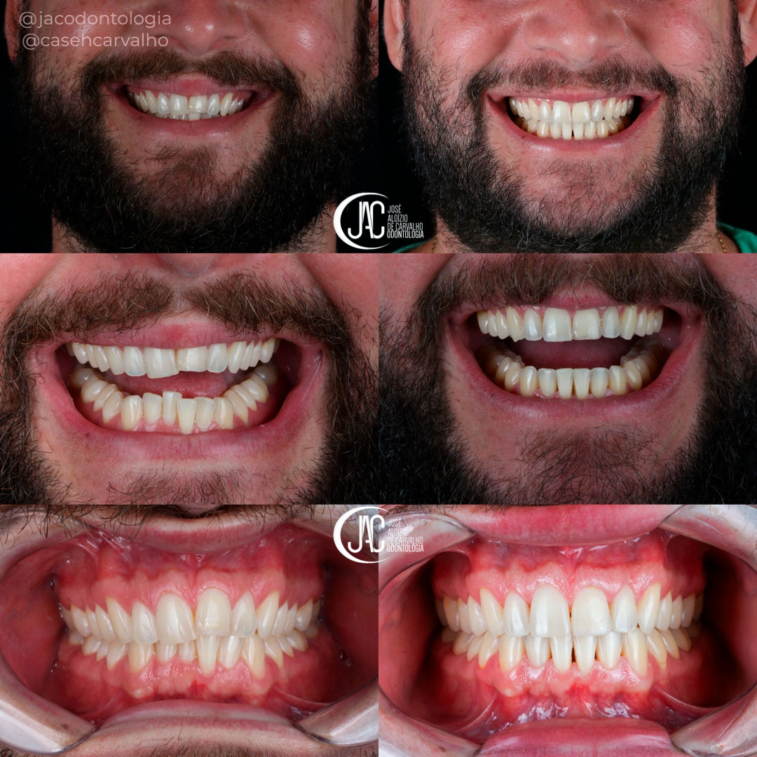 Transformação do Sorriso com Invisalign