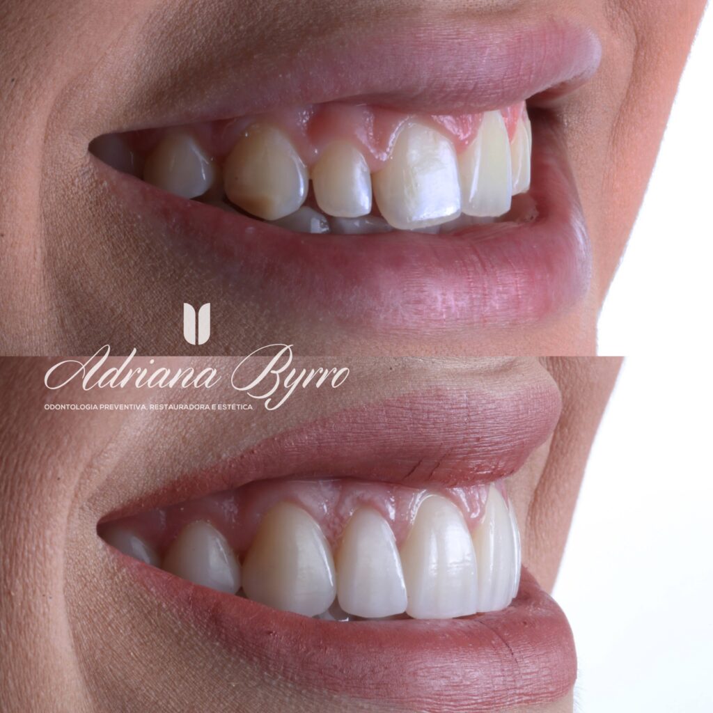 Lentes de Contato Dental