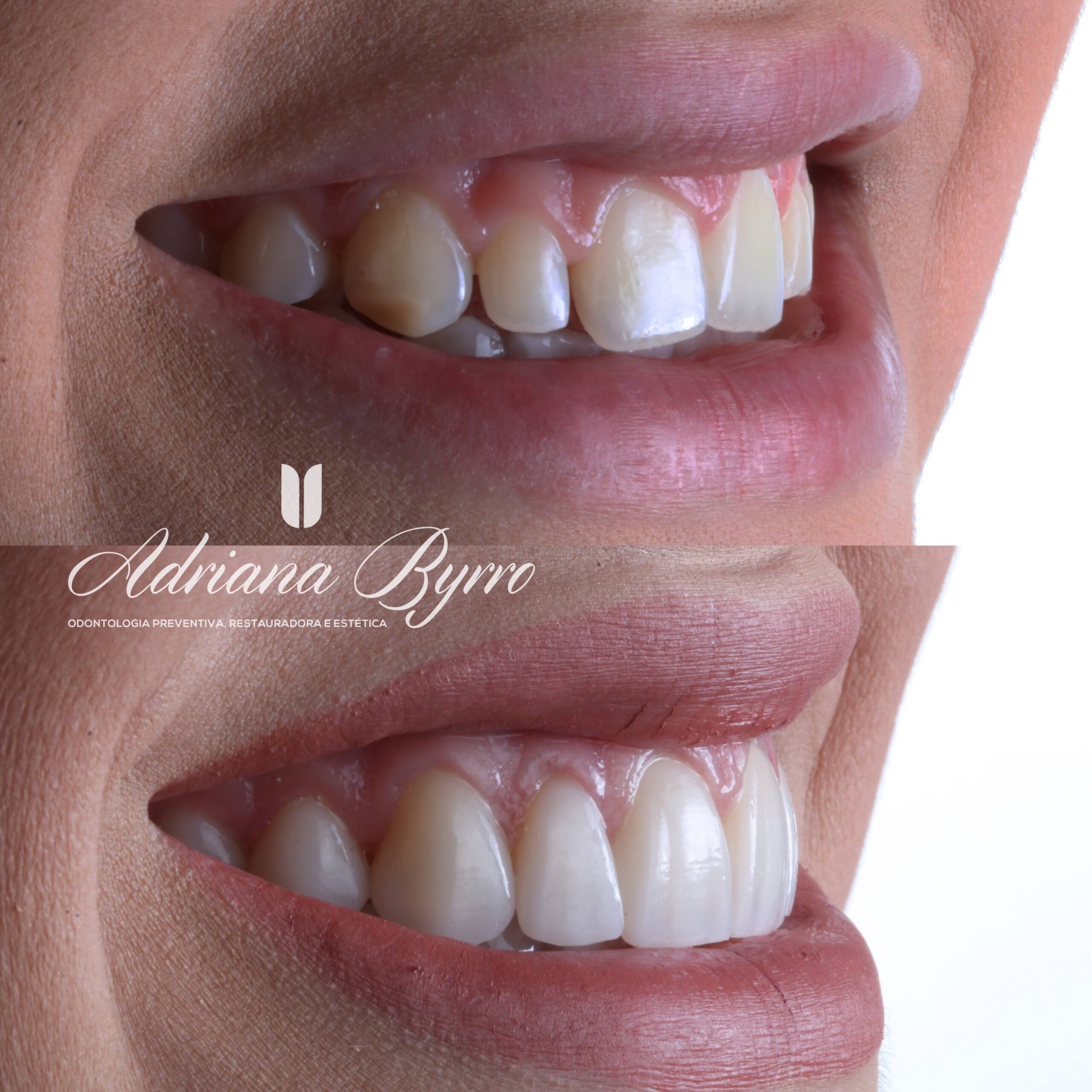 Lentes de Contato Dental