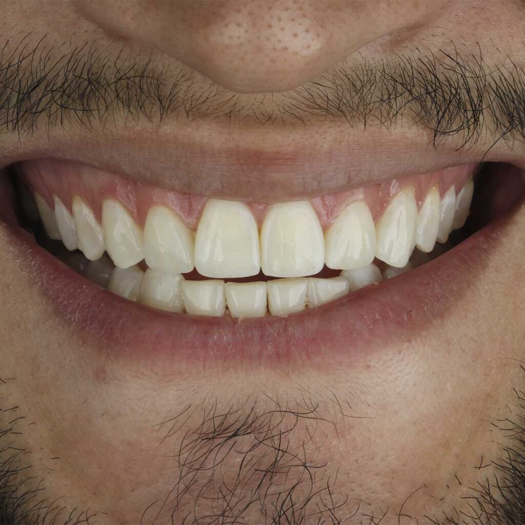 Transforme Seu Sorriso com Lentes de Contato