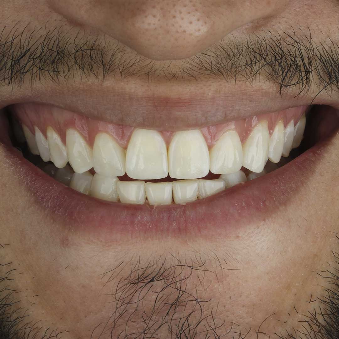 Transforme Seu Sorriso com Lentes de Contato