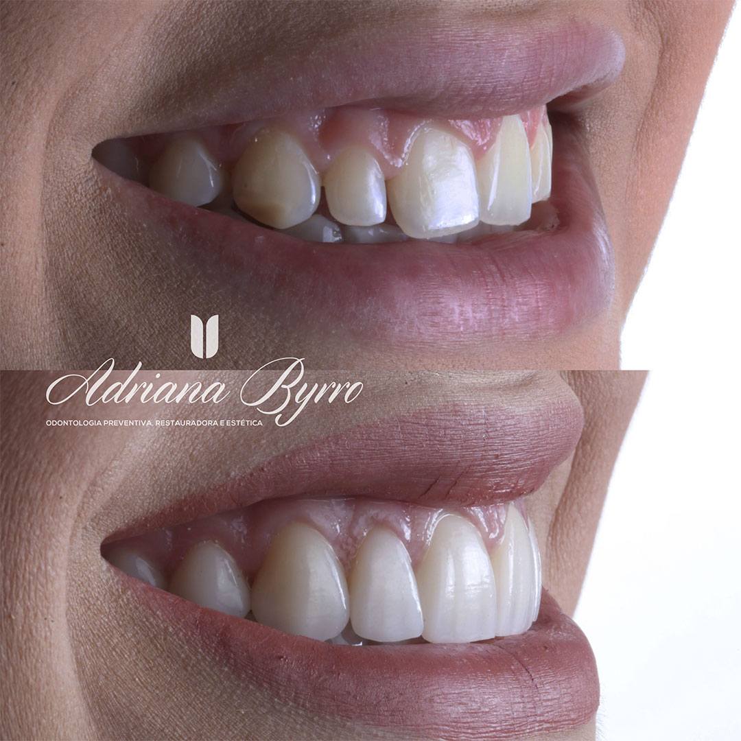 Facetas Dentárias o que São, Para que Servem e Quais os Tipos