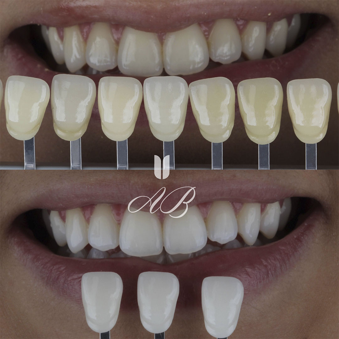 Facetas dentárias em BH